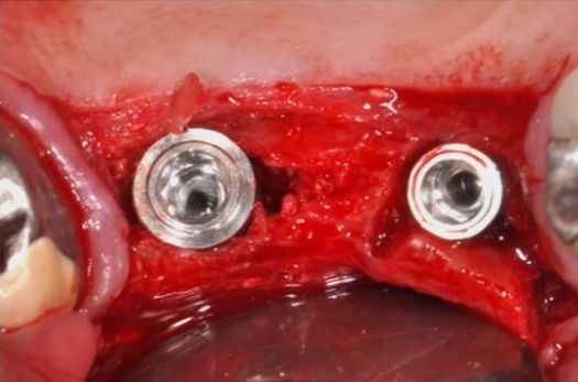 Bone Split with Crestal Sinus Lift 2